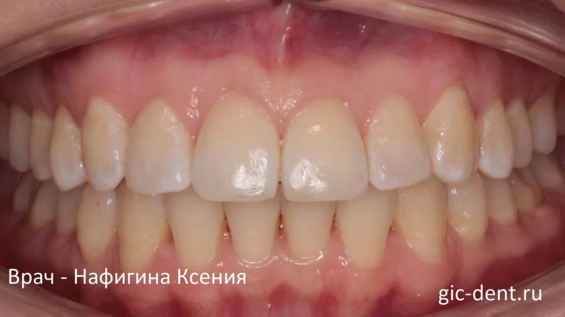 Неправильное смыкание челюстей после предыдущего ортодонтического лечения